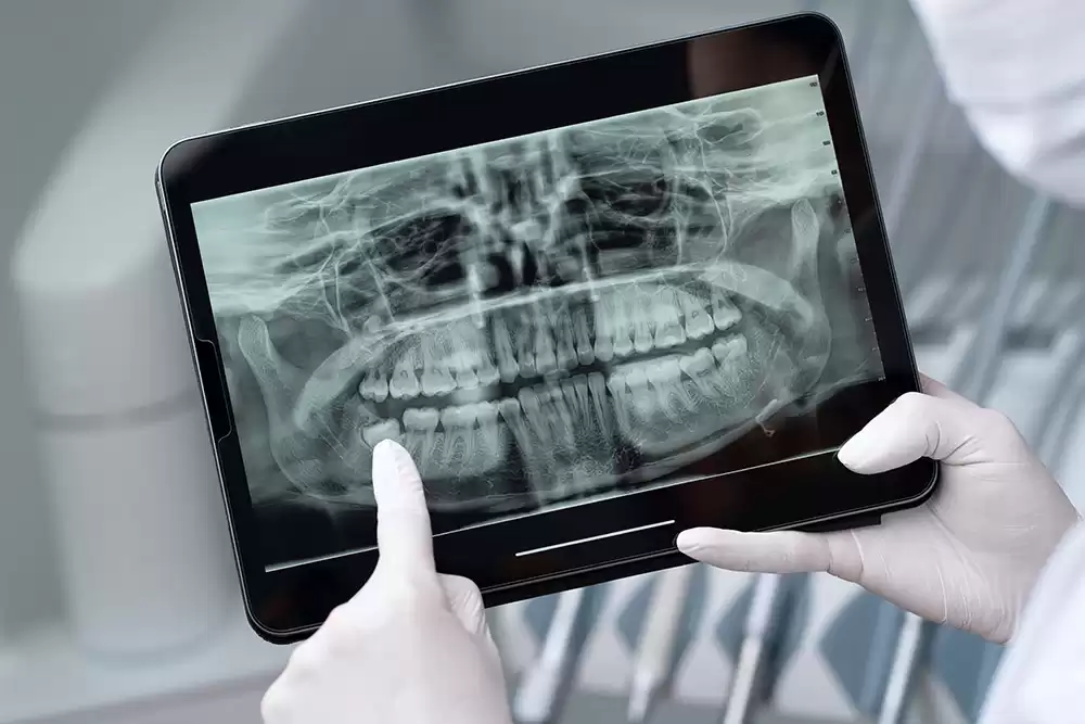 Digital X-Rays